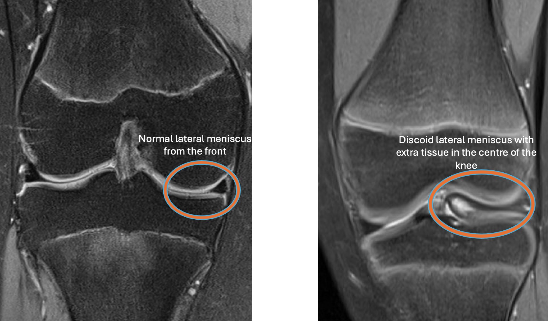 What does it mean if my knee is clicking or popping?