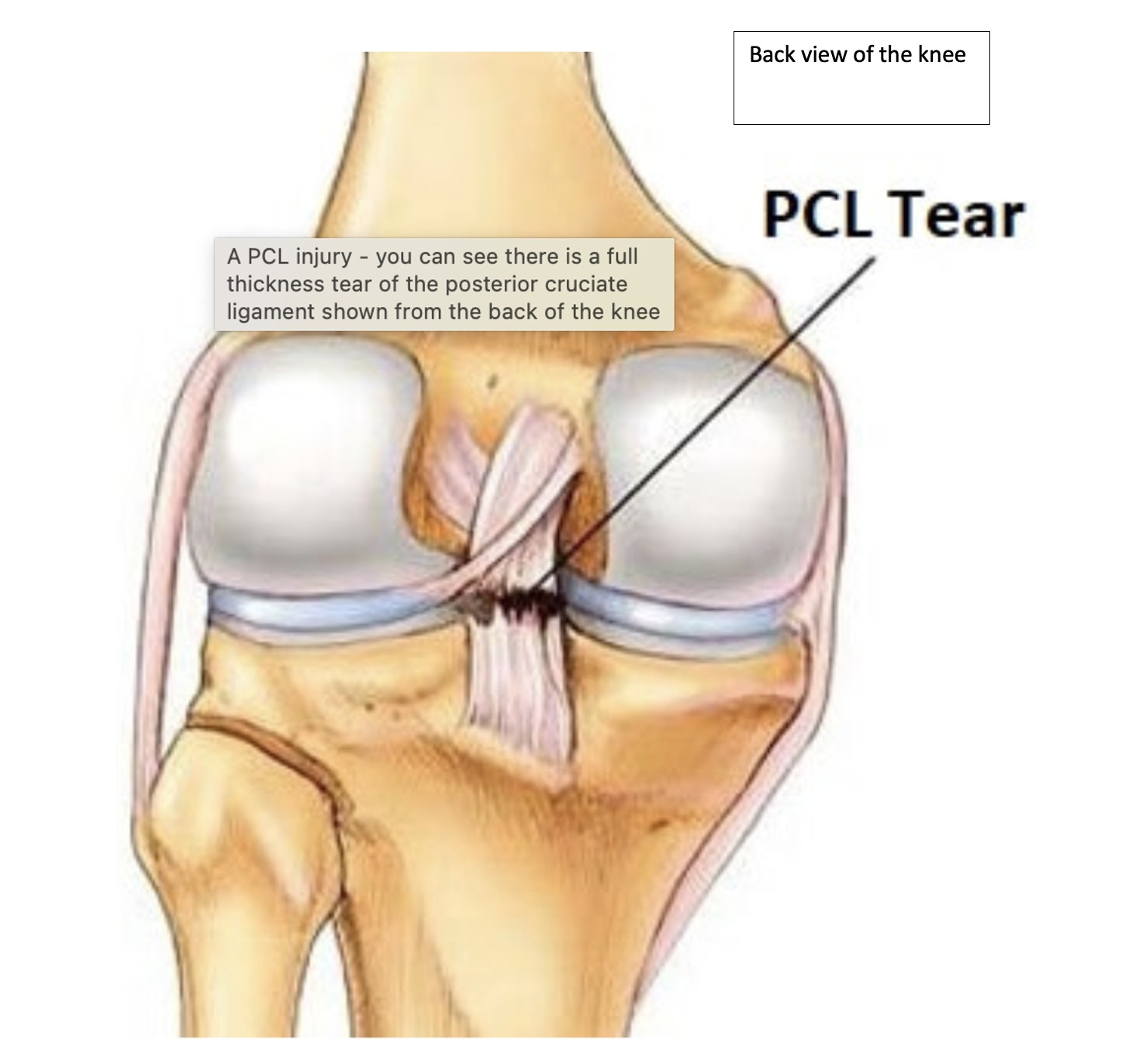 Padel Tennis Injuries: Protecting Your Knees on Court