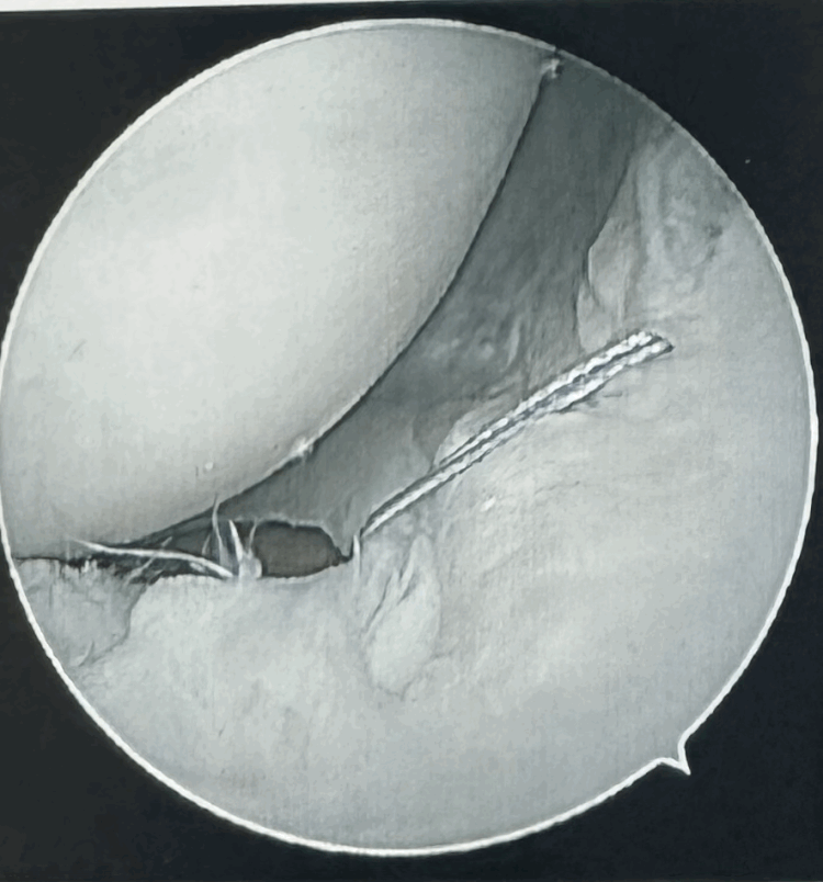 The Role of Knee Arthroscopy