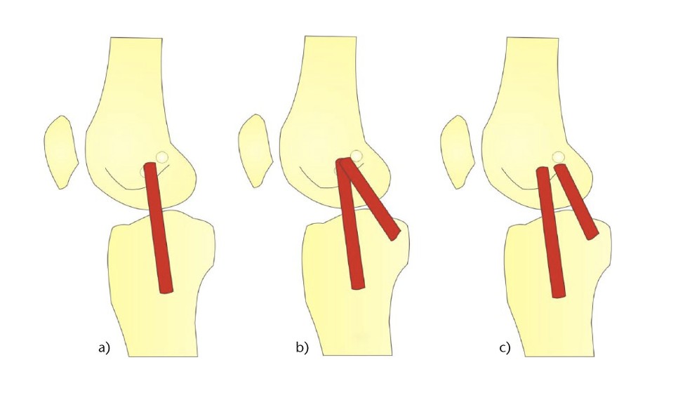 Symptoms of an MCL Injury