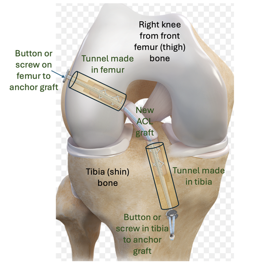 What does ACL reconstruction surgery involve?